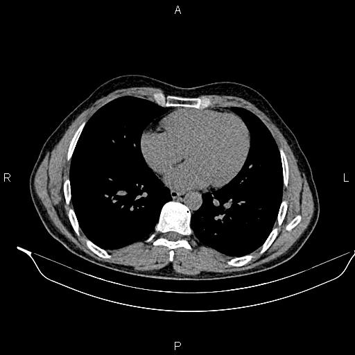 Adrenal myelolipoma (Radiopaedia 87794-104246 Axial non-contrast 2).jpg