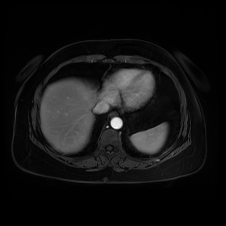 Adrenal myelolipoma - MRI (Radiopaedia 83249-97646 T1 fat sat arterial phase 4).jpg