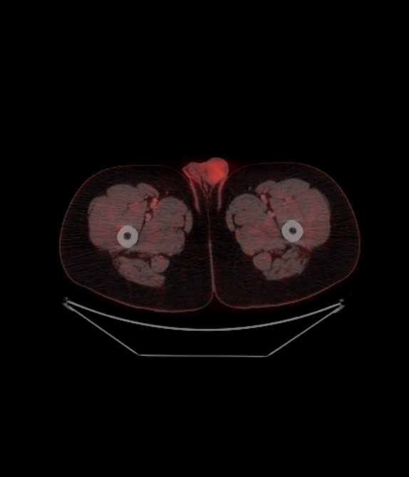 Adrenocortical carcinoma (Radiopaedia 80134-93440 ِAxial 280).jpg