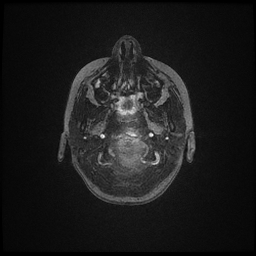 Adrenoleukodystrophy (Radiopaedia 60905-68711 Axial T1 2).jpg