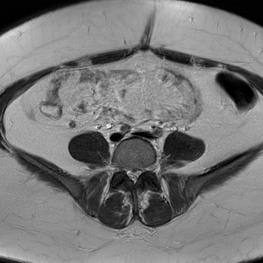 File:Adult granulosa cell tumor of the ovary (Radiopaedia 64991-73953 Axial T2 2).jpg