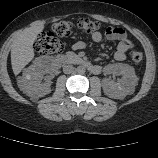Adult polycystic kidney disease (Radiopaedia 59075-66368 Axial non-contrast 37).jpg