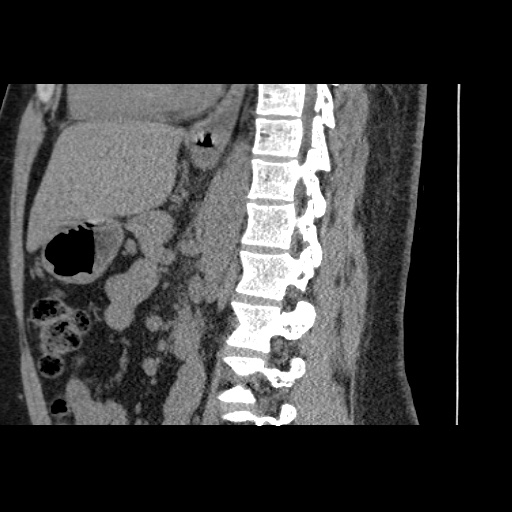 Adult polycystic kidney disease (Radiopaedia 59075-66368 Sagittal non-contrast 47).jpg