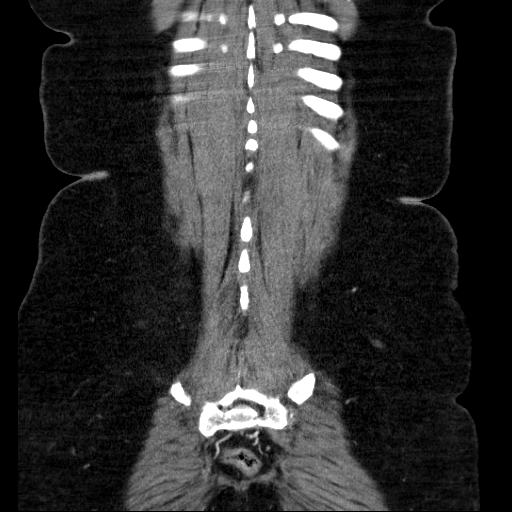 File:Afferent loop syndrome - secondary to incarcerated trocar site hernia (Radiopaedia 82959-97305 Coronal C+ portal venous phase 126).jpg