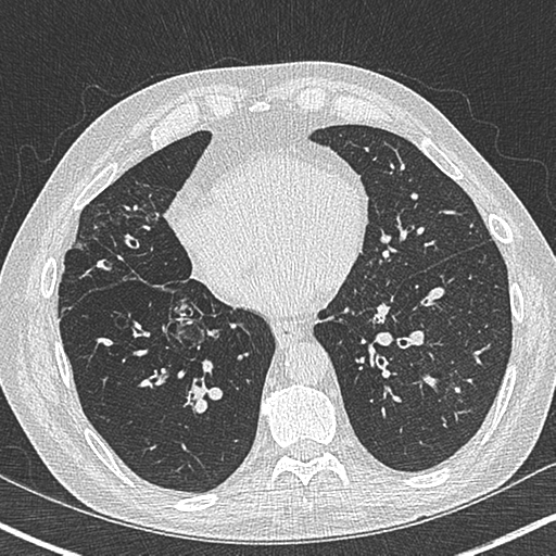 Allergic bronchopulmonary aspergillosis (Radiopaedia 44760-48571 Axial lung window 44).png