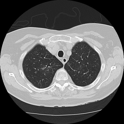 File:Alpha-1-antitrypsin deficiency (Radiopaedia 72058-82557 Axial lung window 12).jpg