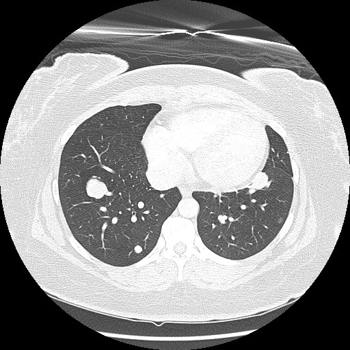 Alveolar soft part sarcoma - right leg (Radiopaedia 59432-67091 Axial lung window 80).jpg