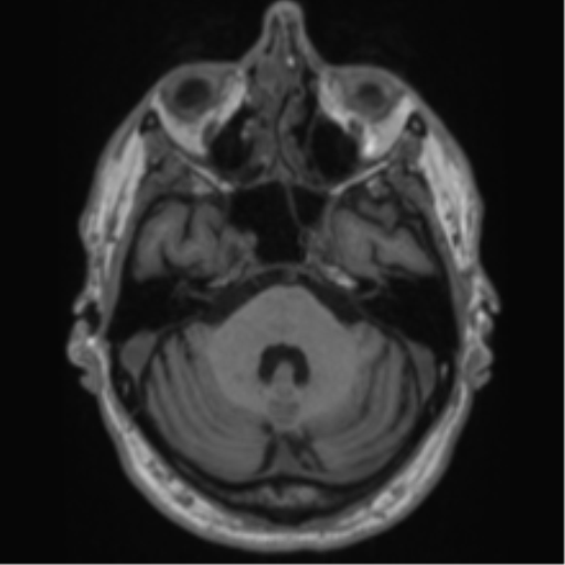 Alzheimer's disease- with Gerstmann syndrome and dressing apraxia (Radiopaedia 54882-61150 Axial T1 18).png