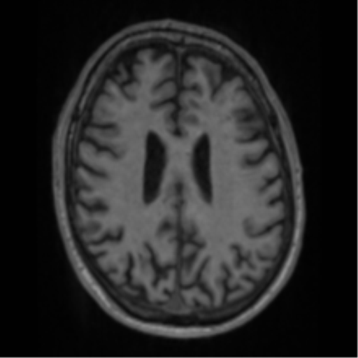 Alzheimer's disease- with apraxia (Radiopaedia 54763-61011 Axial T1 49).png