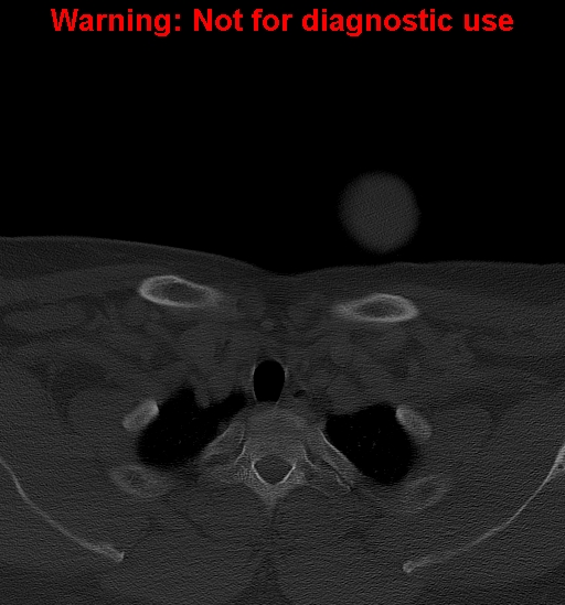 Ameloblastoma (Radiopaedia 33126-34164 Axial bone window 49).jpg