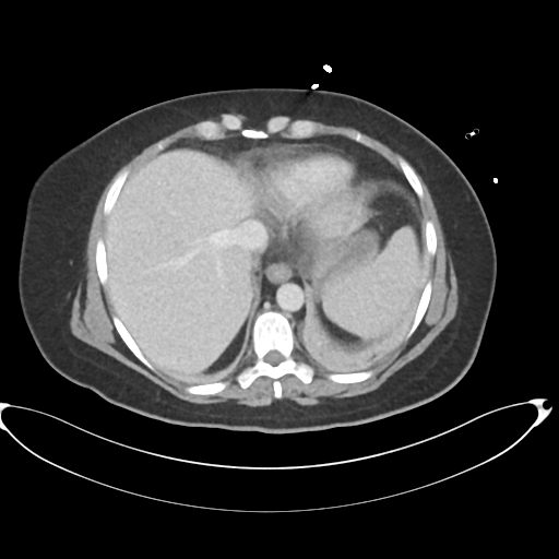 File:Amoebic liver abscess (Radiopaedia 52611-58530 A 14).png