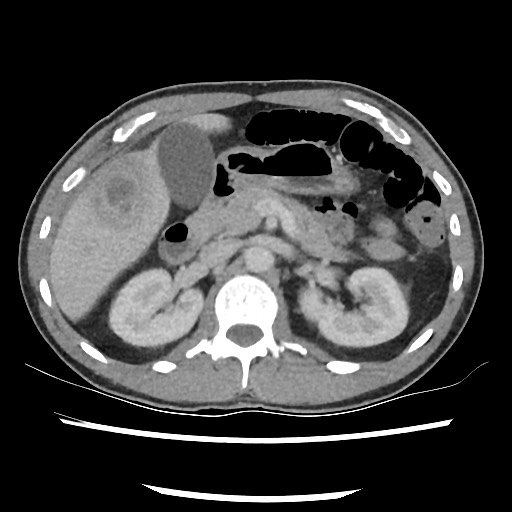 Amoebic liver abscesses (Radiopaedia 55536-62010 A 35).jpg
