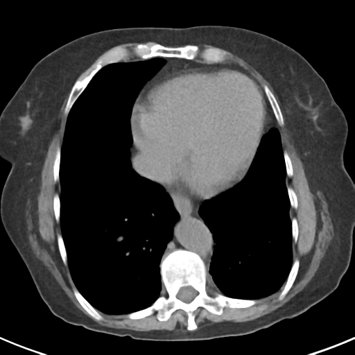 File:Ampullary adenocarcinoma (Radiopaedia 34013-35237 Axial non-contrast 2).png