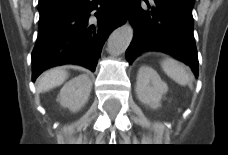 Ampullary adenocarcinoma (Radiopaedia 34013-35241 Coronal 38).png
