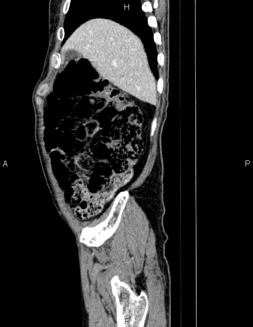 Ampullary adenocarcinoma (Radiopaedia 86093-102032 D 13).jpg