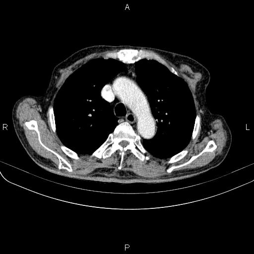 File:Ampullary adenocarcinoma (Radiopaedia 86093-102033 B 24).jpg
