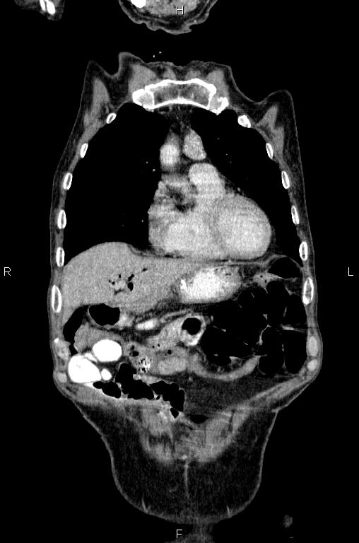 Ampullary adenocarcinoma (Radiopaedia 86093-102033 D 13).jpg