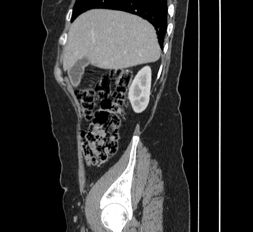 File:Ampullary tumor (Radiopaedia 60333-67998 C 10).jpg