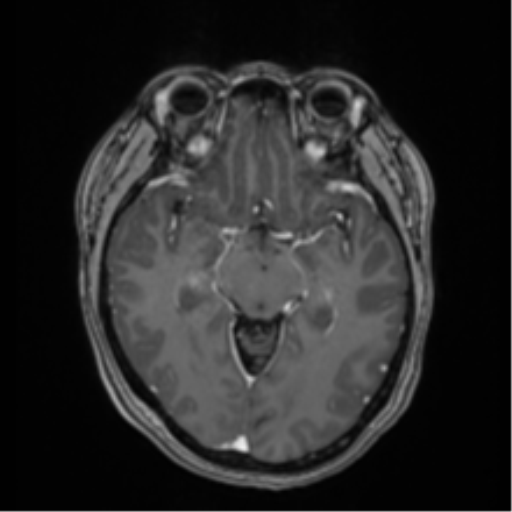 Anaplastic astroblastoma (Radiopaedia 55666-62194 Axial T1 C+ 32).png