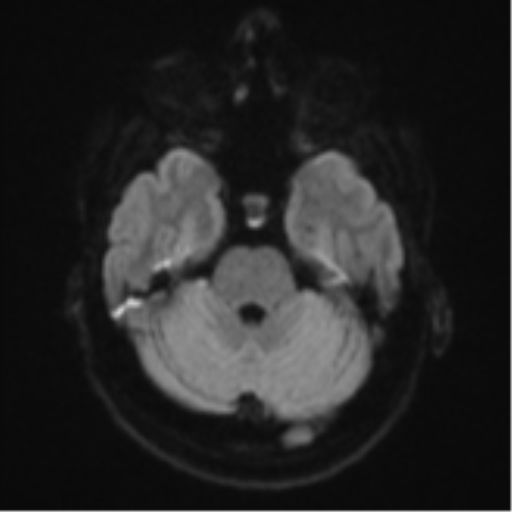 Anaplastic astrocytoma (Radiopaedia 57768-64731 Axial DWI 36).png