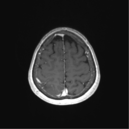 File:Anaplastic astrocytoma (Radiopaedia 86943-103160 Axial T1 C+ 72).png