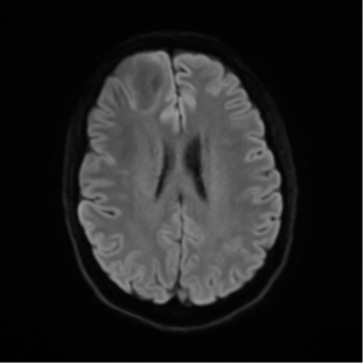 Anaplastic astrocytoma IDH mutant (Radiopaedia 50046-55341 Axial DWI 45).png