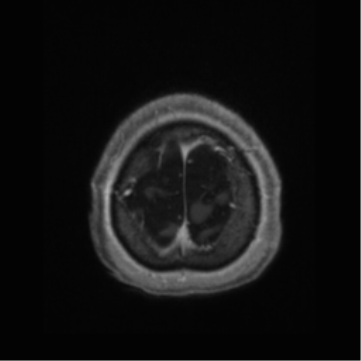 Anaplastic astrocytoma IDH wild-type (pseudoprogression) (Radiopaedia 42209-45277 Axial T1 C+ 121).png