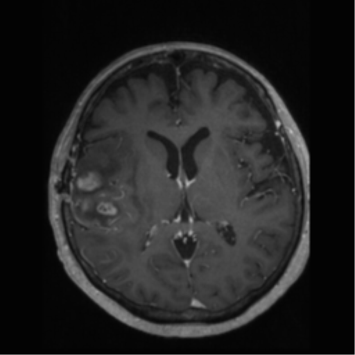 File:Anaplastic astrocytoma IDH wild-type (pseudoprogression) (Radiopaedia 42209-45277 Axial T1 C+ 67).png