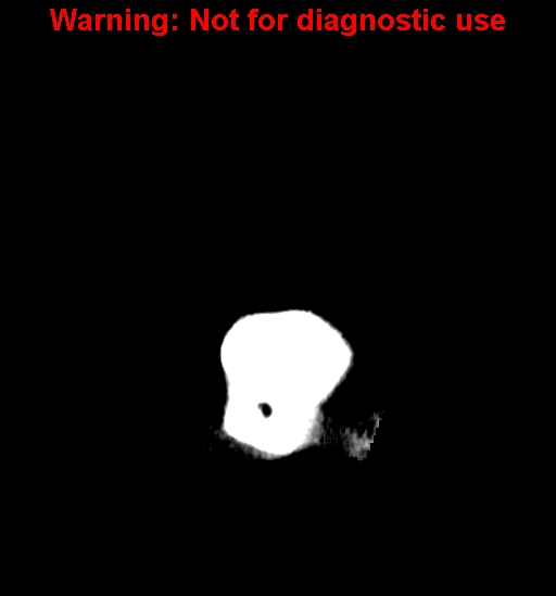 File:Anaplastic ganglioglioma (Radiopaedia 44921-48815 Coronal non-contrast 2).jpg
