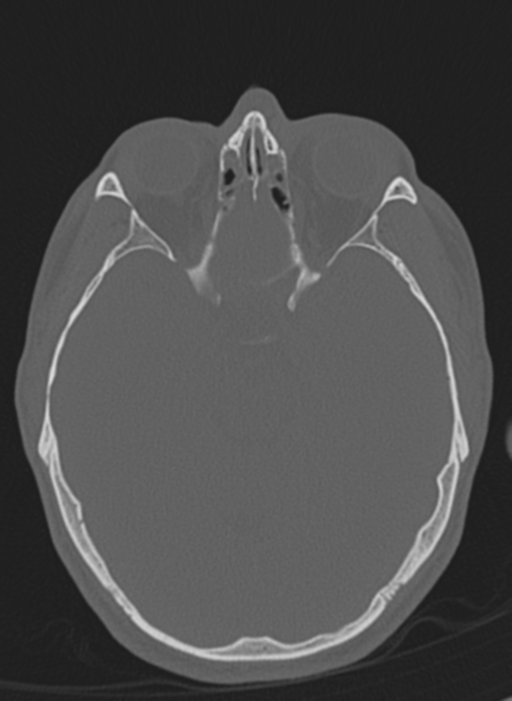 Anaplastic oligodendroglioma with skull fracture (Radiopaedia 74831-85846 Axial bone window 46).png