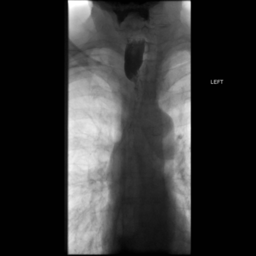 File:Anastomotic stricture post Ivor Lewis esophagectomy (Radiopaedia 47937-52715 B 9).png
