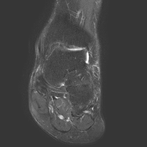 File:Aneurysmal bone cyst of the calcaneus (Radiopaedia 60669-68420 Coronal T2 fat sat 5).jpg