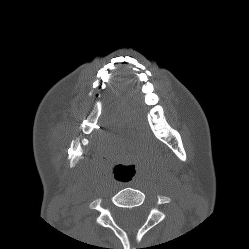 Aneurysmal bone cyst of the mandible (Radiopaedia 43280-46823 Axial bone window 58).jpg