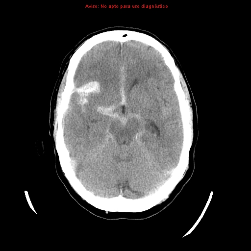 File:Aneurysmal subarachnoid hemorrhage (Radiopaedia 24740-24997 Axial non-contrast 18).jpg