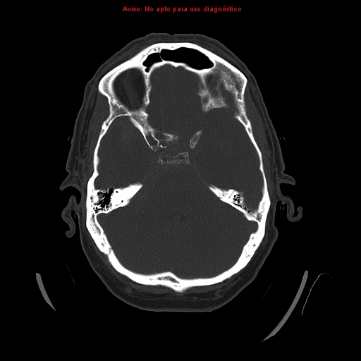 File:Aneurysmal subarachnoid hemorrhage (Radiopaedia 24740-24997 bone window 13).jpg