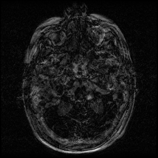 Angioinvasive aspergillosis in the pituitary fossa (Radiopaedia 39676-42010 Ax 3D FIESTA VOLUME 1).png
