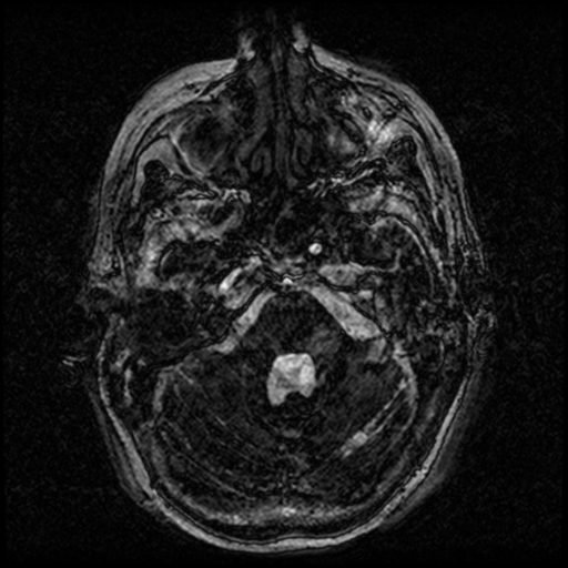 Angioinvasive aspergillosis in the pituitary fossa (Radiopaedia 39676-42010 Ax 3D FIESTA VOLUME 16).png
