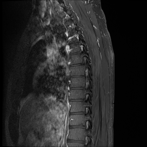 File:Angiolipoma - thoracic spine (Radiopaedia 28242-28479 E 11).jpg