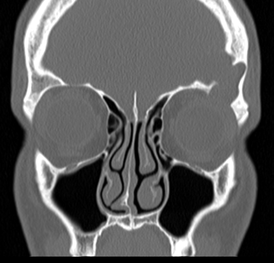 Angular epidermoid cyst (Radiopaedia 46908-51439 Coronal bone window 25).png
