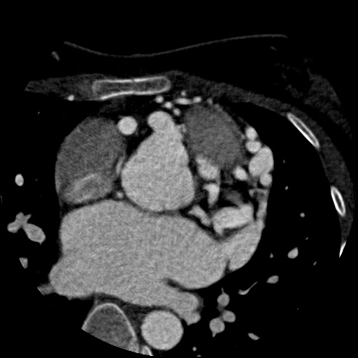 Anomalous left coronary artery from the pulmonary artery (ALCAPA) (Radiopaedia 40884-43586 A 24).jpg