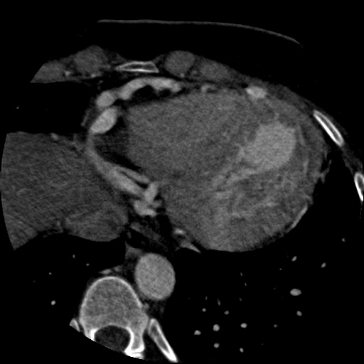 Anomalous left coronary artery from the pulmonary artery (ALCAPA) (Radiopaedia 40884-43586 A 70).jpg