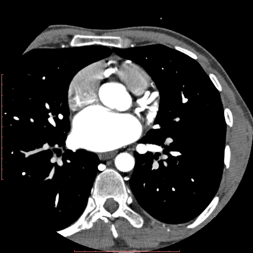 File:Anomalous left coronary artery from the pulmonary artery (ALCAPA) (Radiopaedia 70148-80181 A 119).jpg