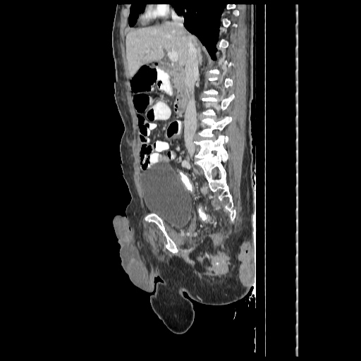 Anorectal carcinoma (Radiopaedia 44413-48064 C 43).jpg
