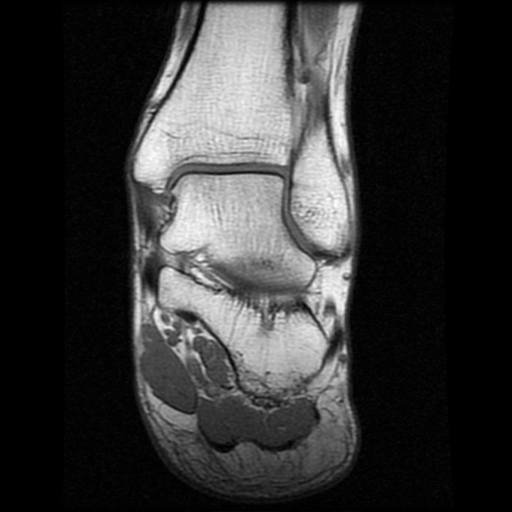File:Anterior calcaneal process fracture (Radiopaedia 74654-85611 Coronal T1 13).jpg