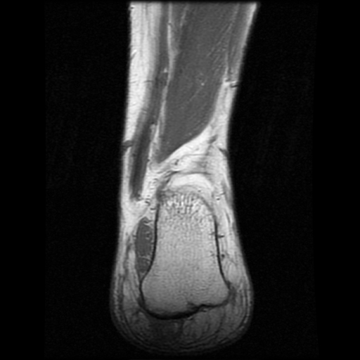 File:Anterior calcaneal process fracture (Radiopaedia 74654-85611 Coronal T1 21).jpg