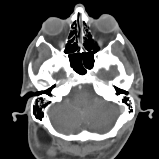 Anterior cerebral artery territory infarct (Radiopaedia 39327-41581 B 45).png