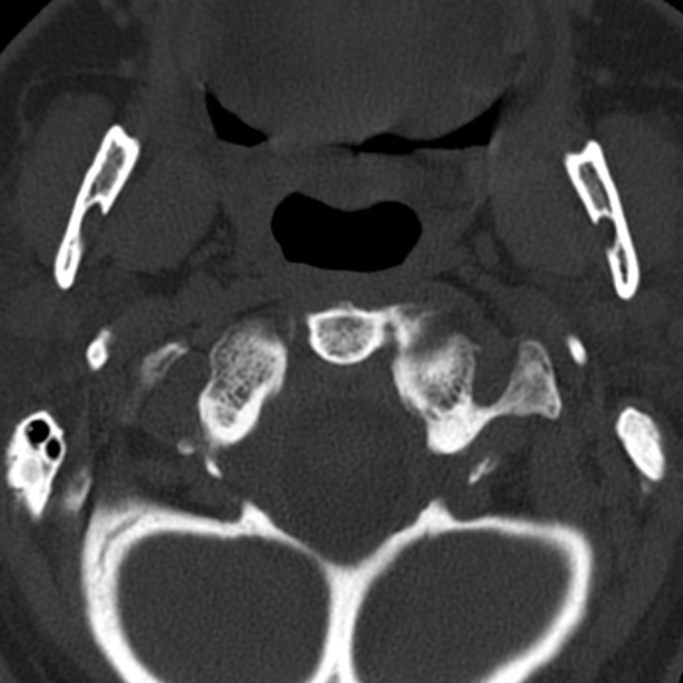 Anterior cervical postdiscectomy arthrodesis (Radiopaedia 32678-33646 Axial bone window 13).jpg