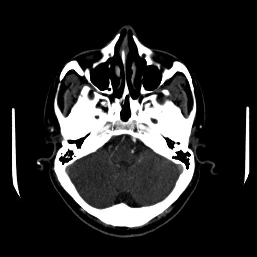 File:Anterior communicating artery aneurysm (Radiopaedia 16633-16335 A 8).jpg