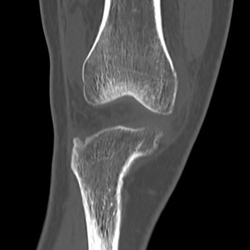 File:Anterior cruciate ligament avulsion fracture (Radiopaedia 58939-66194 Coronal bone window 5).jpg