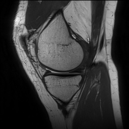 File:Anterior cruciate ligament rupture and posteromedial corner injury (Radiopaedia 67338-76723 Sagittal PD 53).jpg